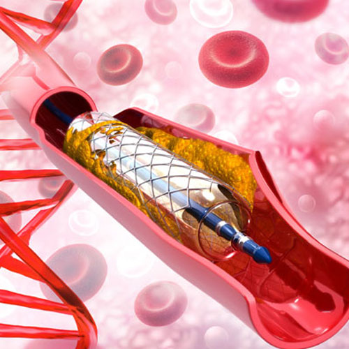 Complex coronary angioplasties