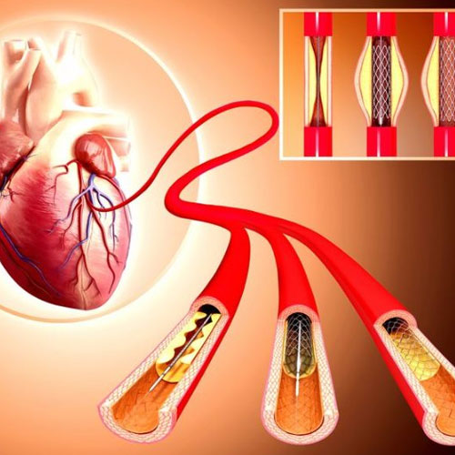 Heart Stenting Surgery in Hyderabad